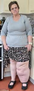 Woman With Leg Weighing 2 Stone More Than The Other Denied Nhs Funding
