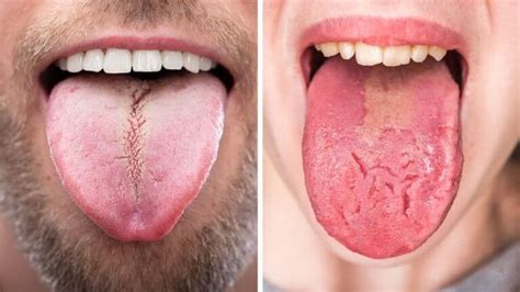 Things Your Tongue Can Tell You About Your Health Minute Read In