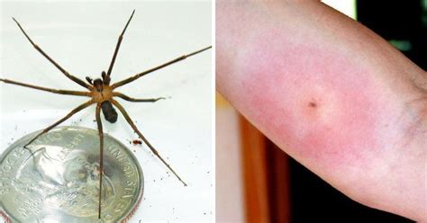 12 Common Bug Bites And How To Recognize Each One Bug Bites Spider