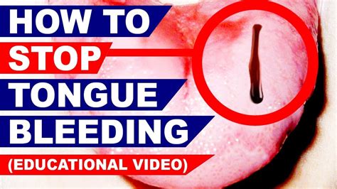 How To Stop Tongue Bleeding Xtreme Truth Educational Video