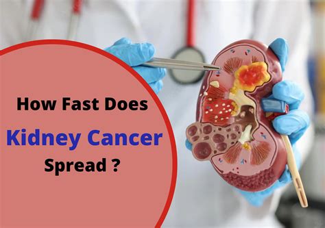 How Fast Does Kidney Cancer Spread Urolife Clinic
