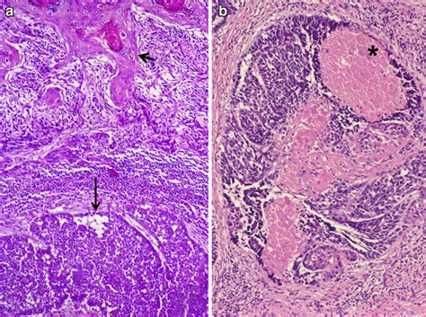 Basaloid Squamous Cell Carcinoma Invasive Squamous Cell Carcinoma In