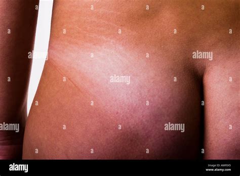 Naked Woman Buttock With Cellulite And Stretch Marks Striae Stock Photo Alamy