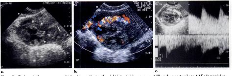 Figure 5 From Interstitial Line Sonographic Finding In Interstitial