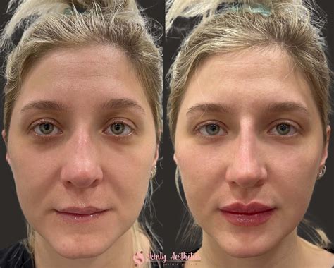 Under Eye Fillers Before After Results At Skinly