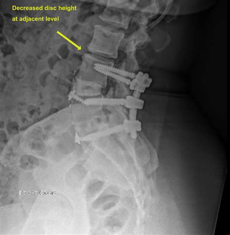 Lumbosacral Spine Plain Radiographs Radiology Key