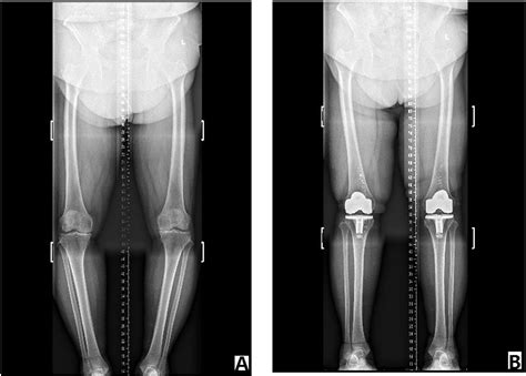 Radiographic Assessment Of Kneeankle Alignment After Total Knee