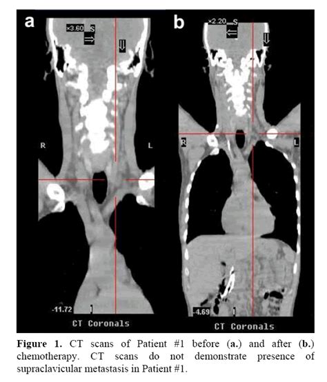 Isolated Supraclavicular Lymph Node Metastasis In Pancreatic Aden