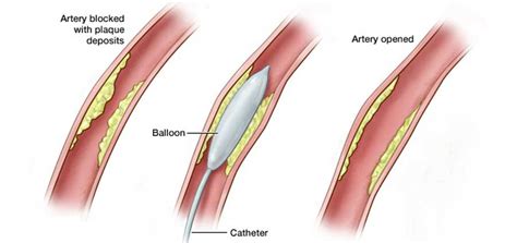 Peripheral Angioplasty Total Vascular Vein And Wound Clinic