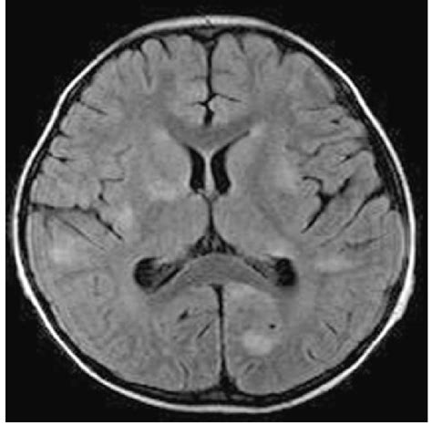 Axial T2 Weighted Mri Of The Patients Brain Several High Intensity