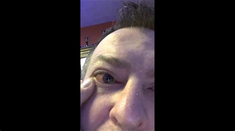 Eyeball Blister Alergic Reaction Xmas Day 2015 Youtube