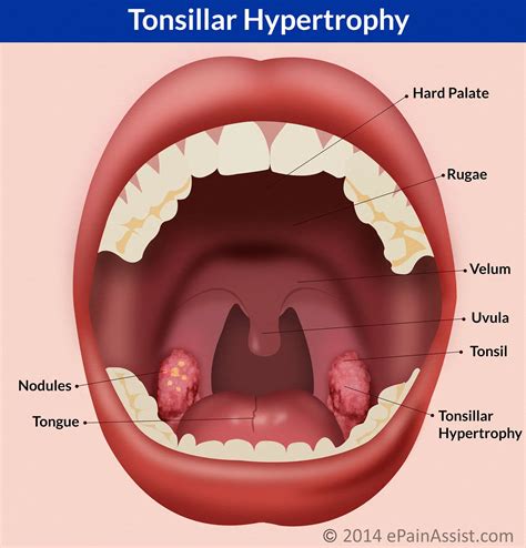 Tonsils And Adenoids Tonsillitis