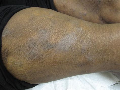 Eczema Of Arm On Black Skin With Erythematous Patches Eczema In Skin