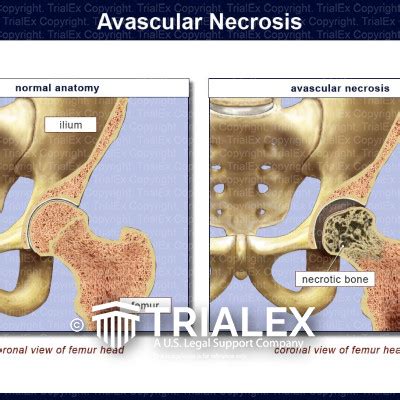 Avascular Necrosis TrialExhibits Inc