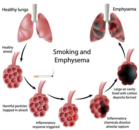 Emphysema Is A Chronic Lung Disease That Is Caused By Damage To The