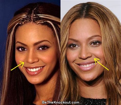 Beyonce Nose Job Before And After 2022