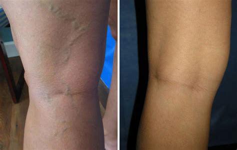 Blue Veins Treatment Causes And Prevention In Jacksonville Florida