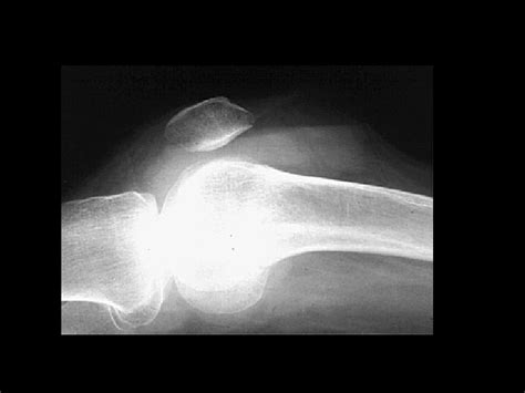 Aneurysmal Bone Cyst Findings Expansile Lytic Lesion Of
