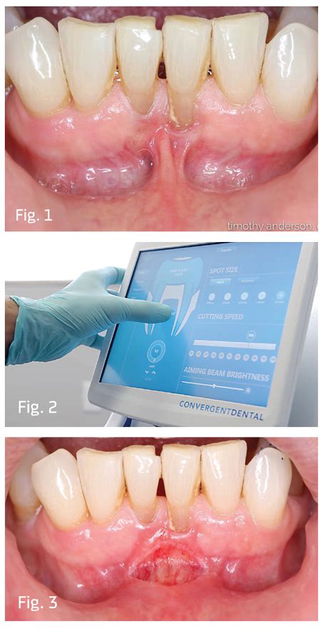 Show Your Work Mandibular Frenectomies Made Simple By Dr Timothy