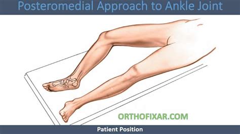 Posteromedial Approach To Ankle Joint 2023 Orthofixar