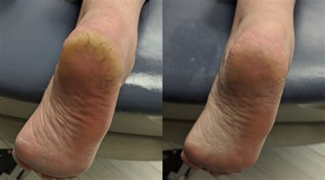 Dry Cracked Skin On Heels Treeready