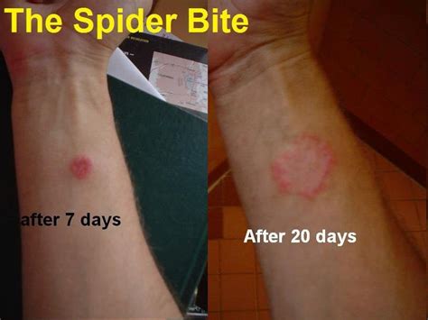 My Recent Spider Bite Encounter After 7 Days After 20 Days Pics