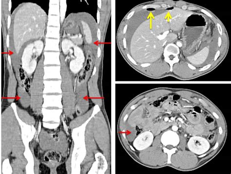 Blunt Abdominal Trauma Small Bowel And Mesenteric Injuries Radiology