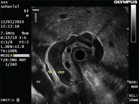 Radial Endoscopic Ultrasound Showing Grossly Dilated Common Bile Duct
