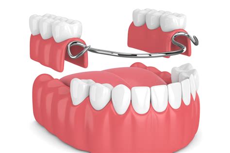 Partial Dentures For Back Teeth All Are Present No Teeth Is Missing