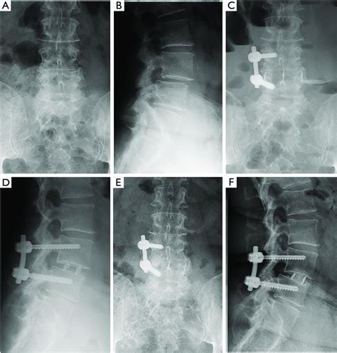 Lateral Lumbar Interbody Fusion With Unilateral Pedicle Screw Fixation