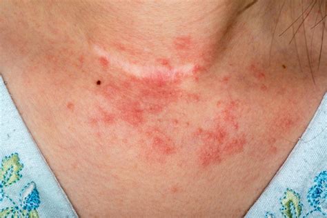 Types Of Eczema Symptoms And Causes