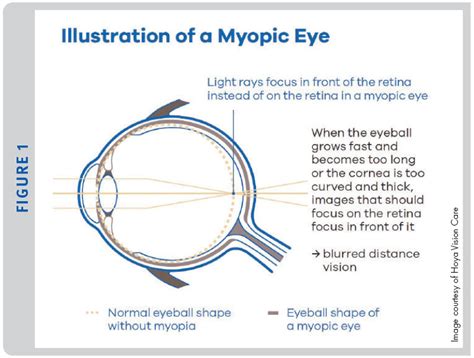 myopia management spectacle lenses what why and when