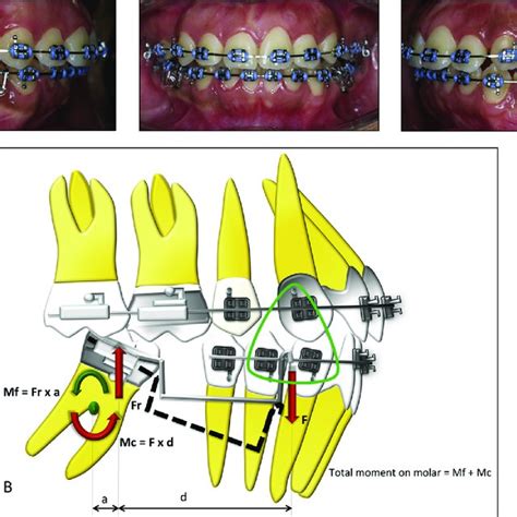 A Placement Of Uprighting Spring To Upright Mandibular Second Molars