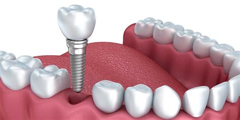 Single Tooth Dental Implants Dental Implants Petrucco Dentistry