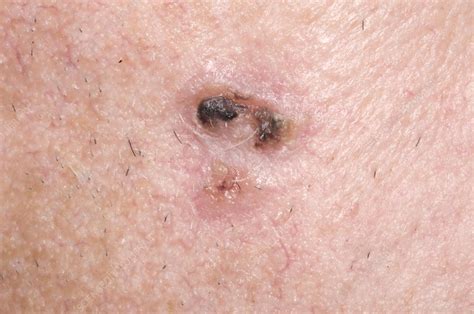 Basal Cell Carcinoma Stock Image M1310772 Science Photo Library