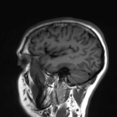 Normal Brain Mri Radiology Case Mri Mri Brain