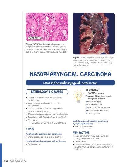 Nasopharyngeal Carcinoma Osmosis