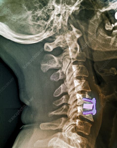 Cervical Intervertebral Disc Implant X Ray Stock Image C0337533