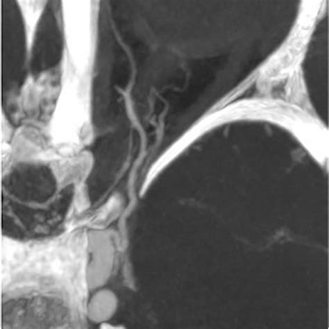A Flat Panel Ct With Injection Of Diluted Contrast Medium Obtained