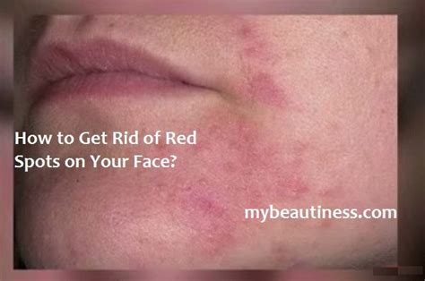 Best 25 Red Spots On Face Ideas On Pinterest Pimple