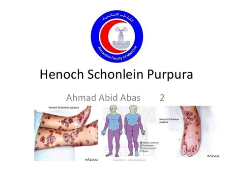 Henoch Schonlein Purpura