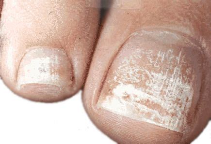 White Toenail Fungus Nails Turning White Due To Fungal Infection