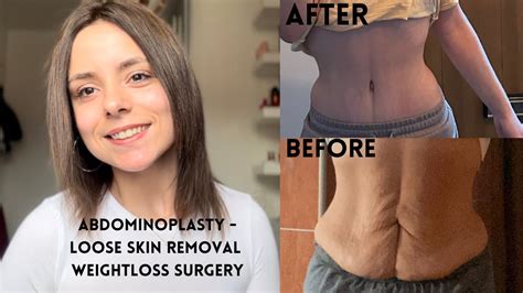 Abdominoplasty surgery + how I dealt with my recovery - YouTube