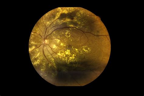 View Inside Human Eye Disorders Showing Retina Optic Nerve And Macula Severe Age Related