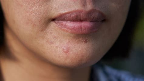 5 Cheap Products Dermatologists Swear By To Get Rid Of Pimples Shefinds