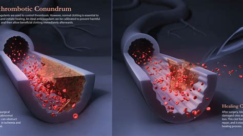 Kidney Disease Progression In Adpkd Medical Animation Scientific