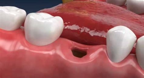 Infected Tooth Socket After Extraction Oral Health