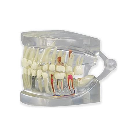 Buy Clear Dental Model Human Body Anatomy Replica Of Jaw Wteeth For