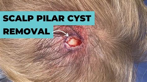 Scalp Pilar Cyst Removal Contour Dermatology Youtube