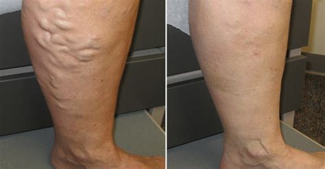 Varicose Veins General Treatments Available Today